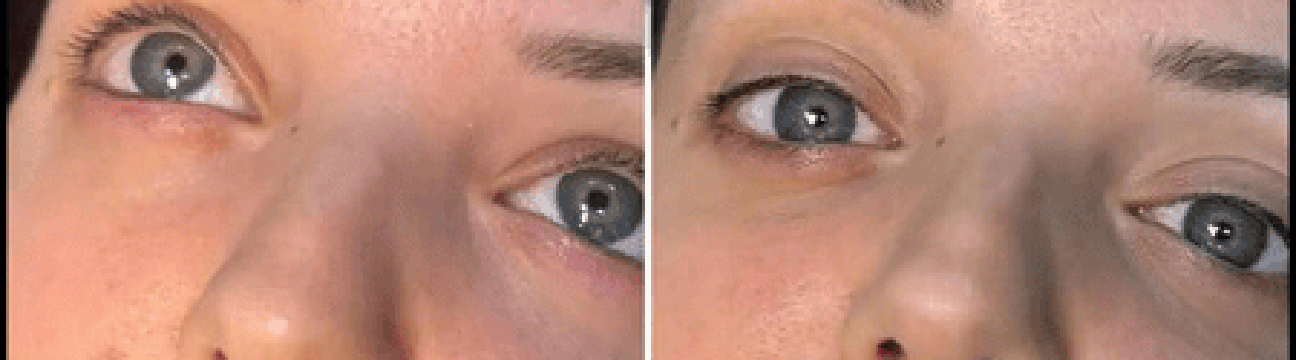 Dermal Fillers